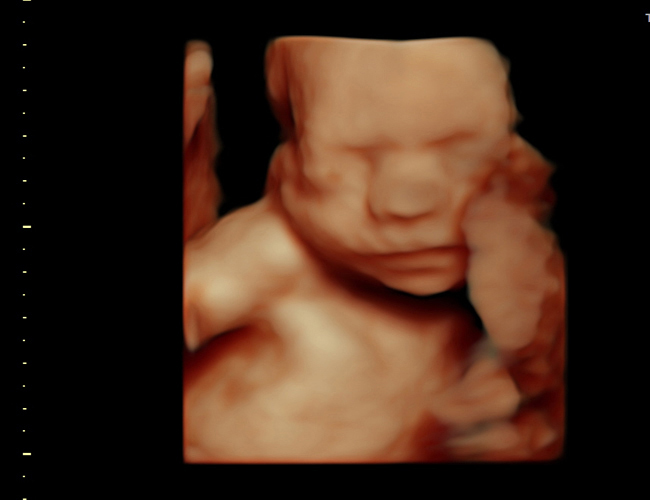 3D ultrasound image at 25 weeks